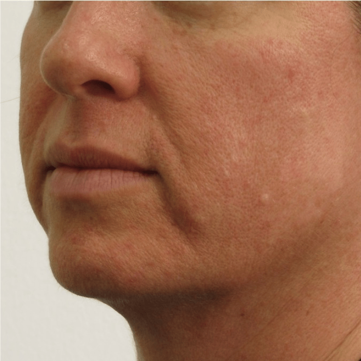 Before microneedling treatment at Essential Aesthetics & Wellness MedSpa in Chantilly VA