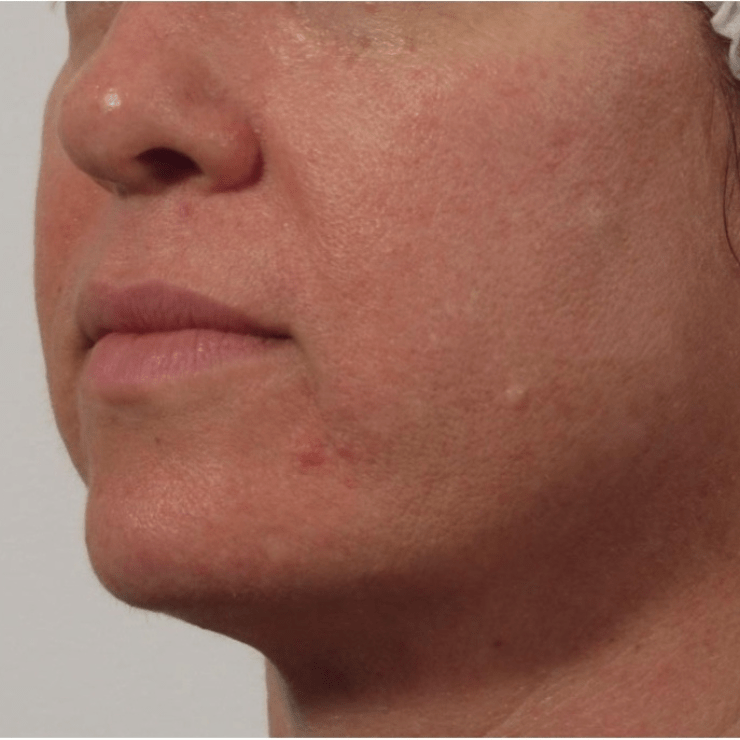 After microneedling treatment at Essential Aesthetics & Wellness MedSpa in Chantilly VA