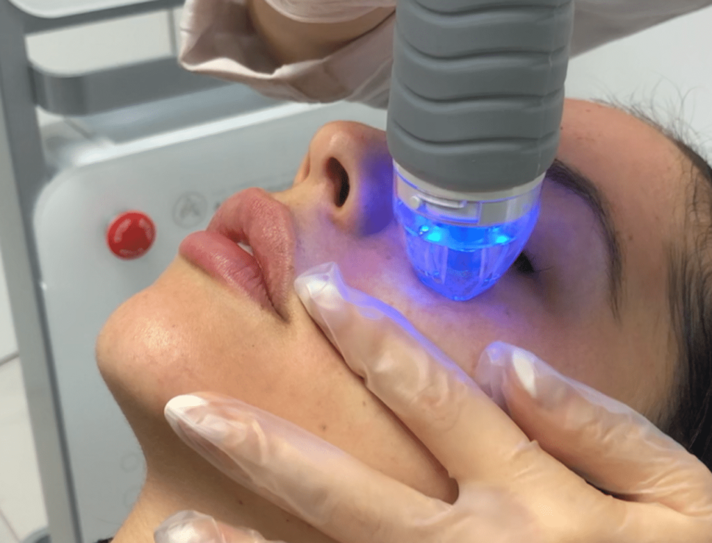 Client receiving RF microneedling treatment at Essential Aesthetics & Wellness MedSpa in Chantilly VA