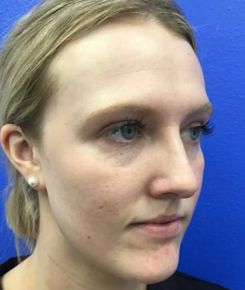 Before undergoing MedSpa treatments at Essential Aesthetics & Wellness MedSpa in Chantilly, VA – natural skin appearance before rejuvenation