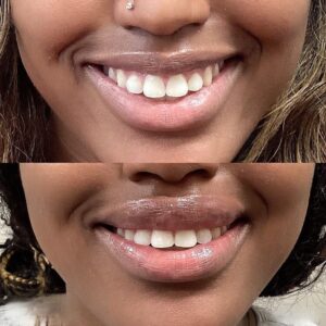 lip filler near by Dr Govil